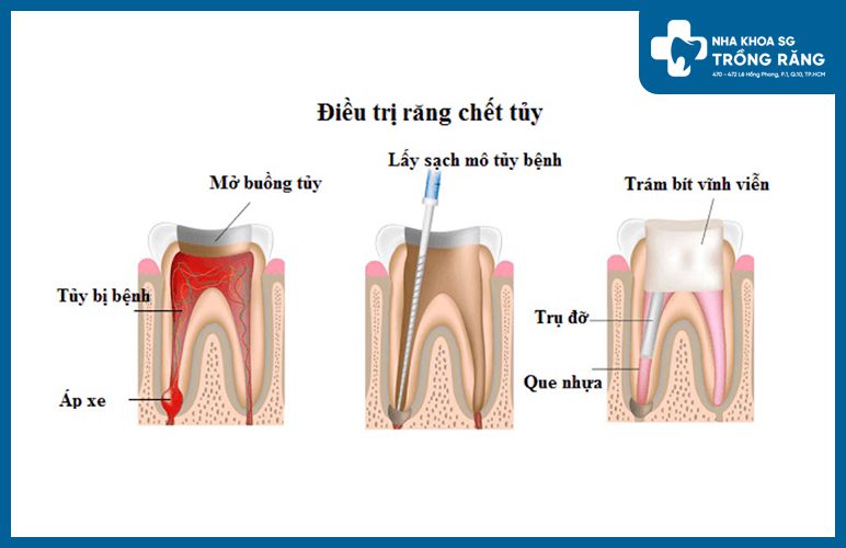quy trình lấy tủy răng bằng máy quy trình lấy tủy răng bằng máy