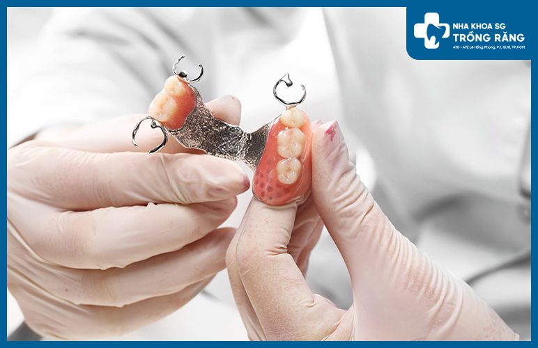 răng giả composite