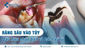 răng sâu vào tủy
