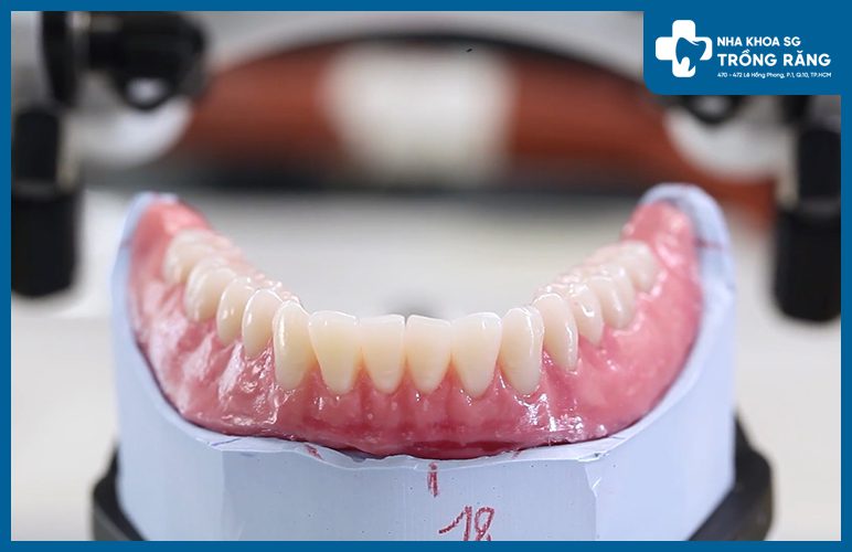 răng nhựa giả tự nhiên