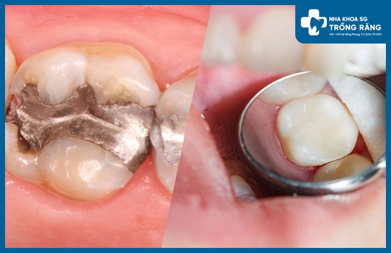 trám lại vết trám cũ