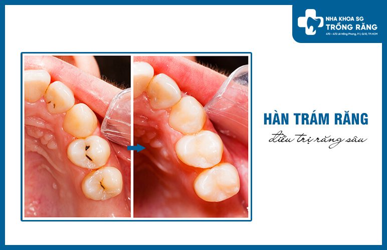 trám răng sâu nhẹ