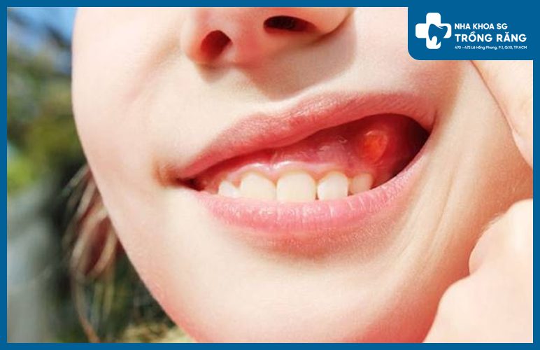 u răng có nguy hiểm không