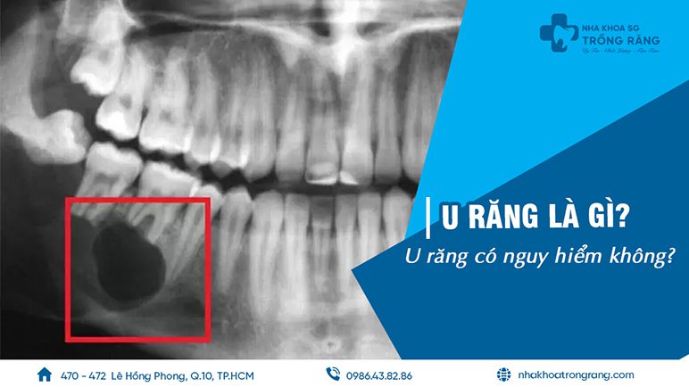 u răng là gì