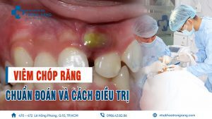 viêm chóp răng là gì