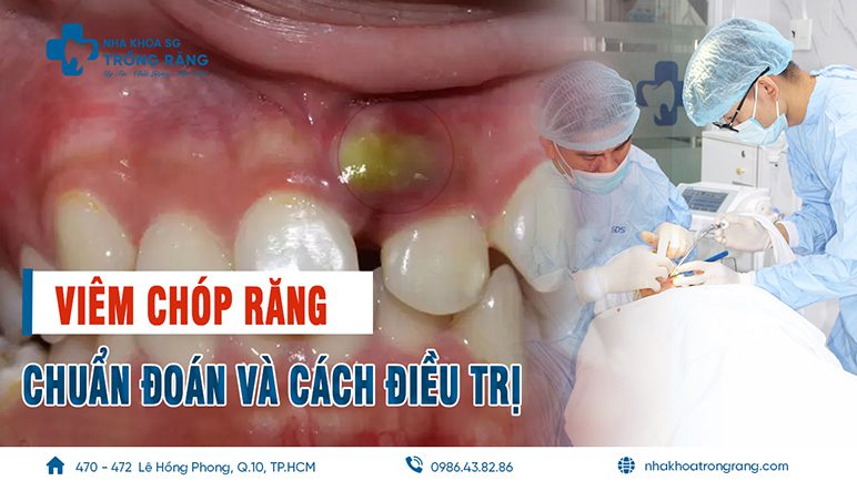 viêm chóp răng là gì