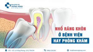 nhổ răng khôn ở bệnh viện hay phòng khám