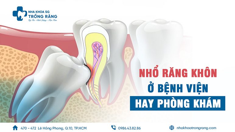 nhổ răng khôn ở bệnh viện hay phòng khám