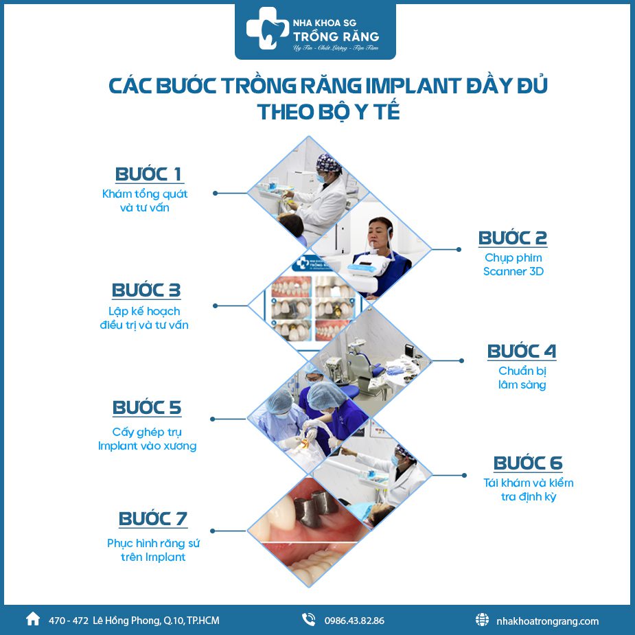 quy trình trồng răng Implant