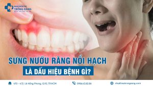 sưng nướu răng nổi hạch là bệnh gì