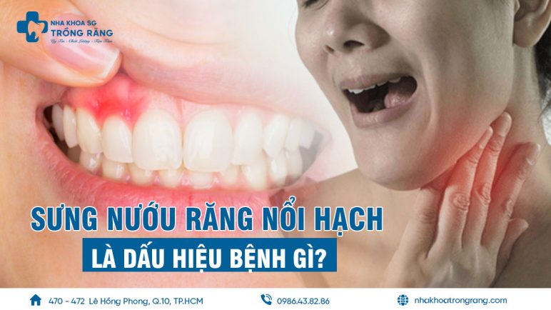 sưng nướu răng nổi hạch là bệnh gì