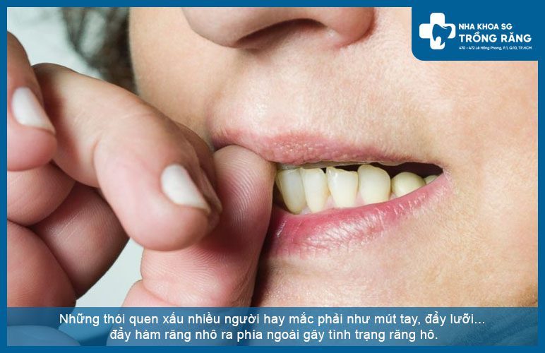 tại sao răng ngày càng hô