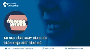 tại sao răng ngày càng hô