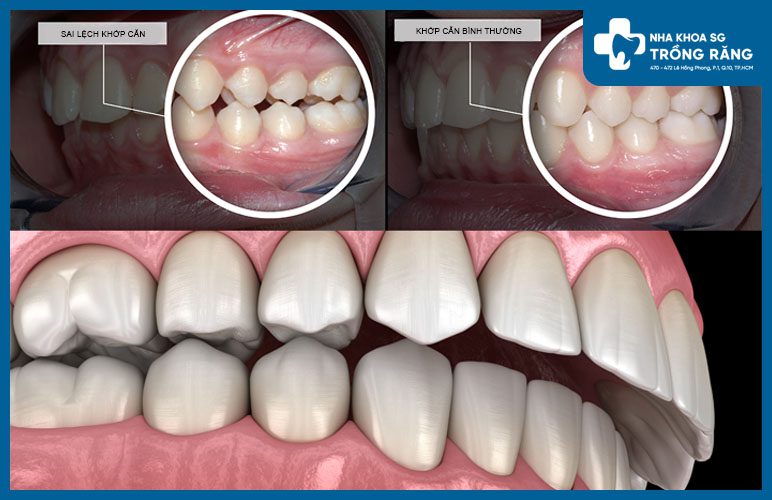 tình trạng răng hô là gì