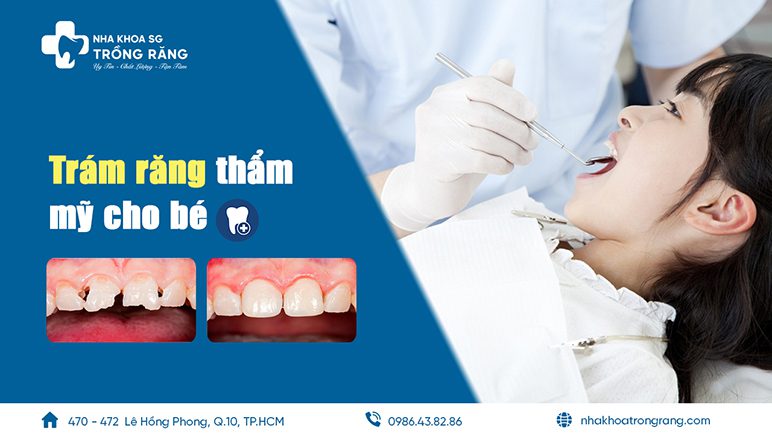 trám răng thẩm mỹ cho bé