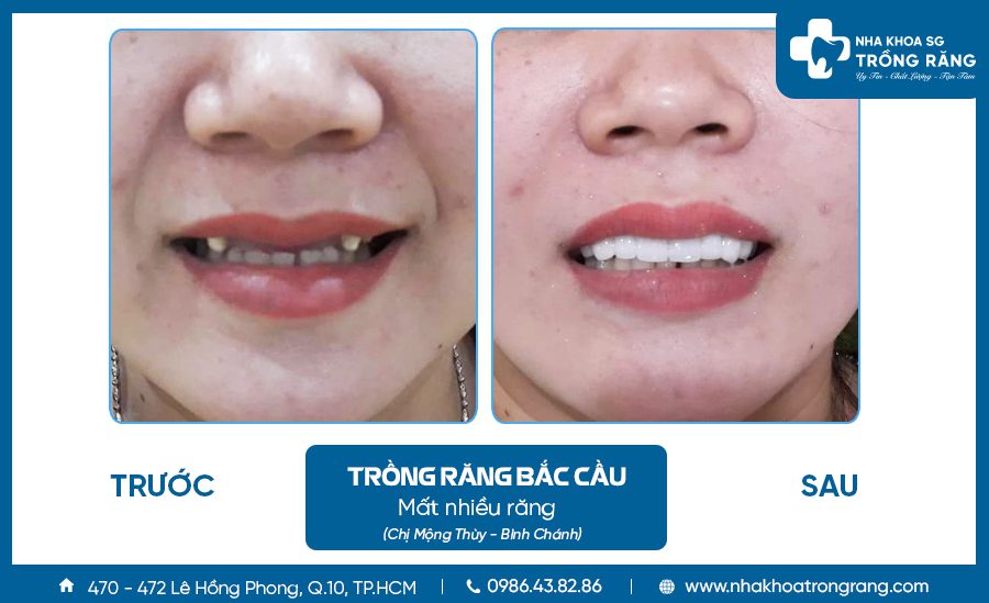 Trồng răng sứ khi bị mất răng những phương pháp hiệu quả