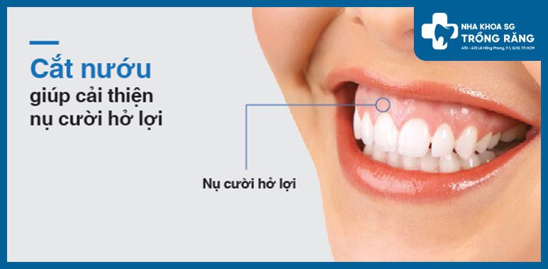 Cắt nướu là gì? Trong trường hợp nào thì cần phải cắt nướu?