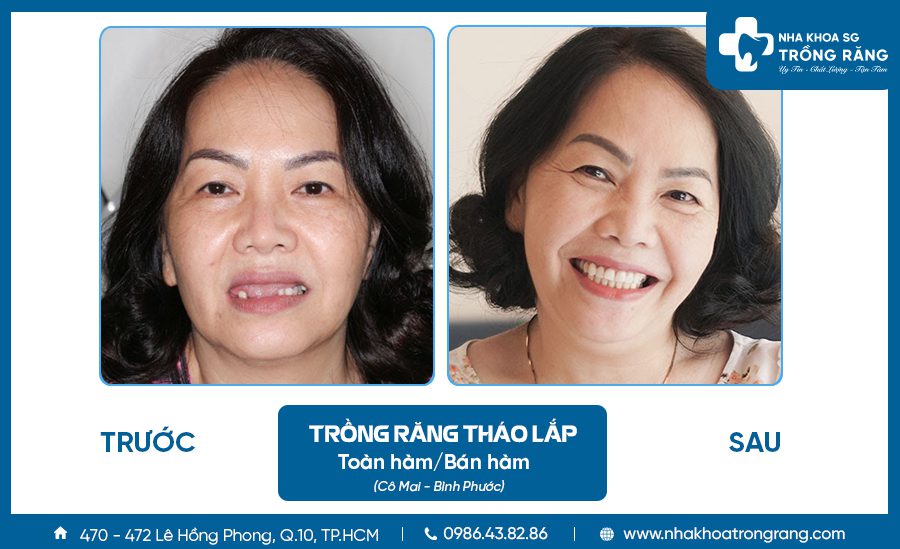 Trồng răng sứ khi bị mất răng những phương pháp hiệu quả