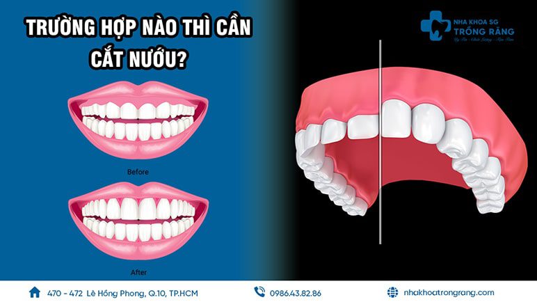 Cắt nướu là gì? Trong trường hợp nào thì cần phải cắt nướu?