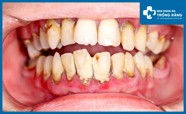 viem nha chu gay dau rang