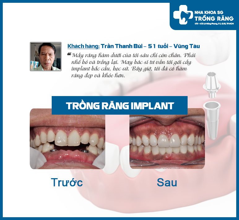 Nha khoa chuyên cấy ghép implant tại tp HCM