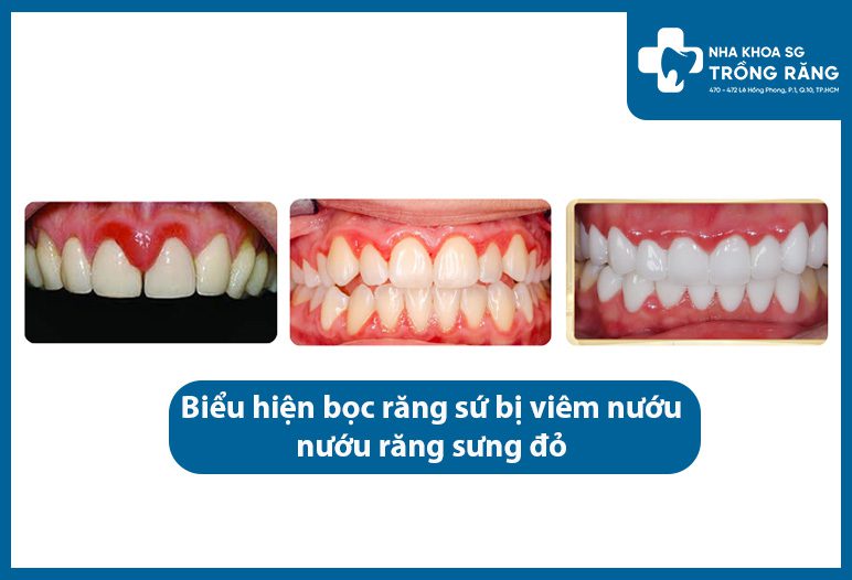 bọc răng sứ bị viêm nướu