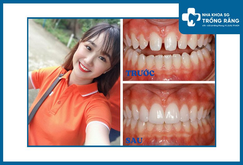 hinh anh dan rang su