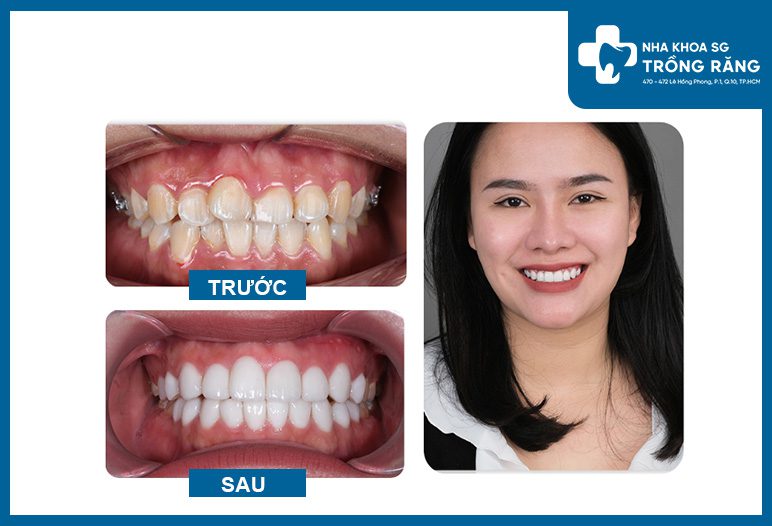 Hình ảnh trước và sau khi bọc răng sứ