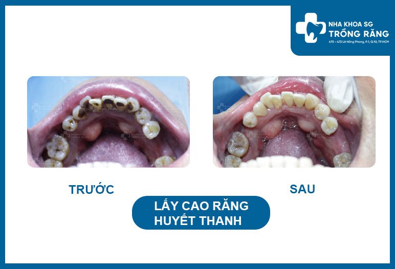 lay cao rang huyet thanh