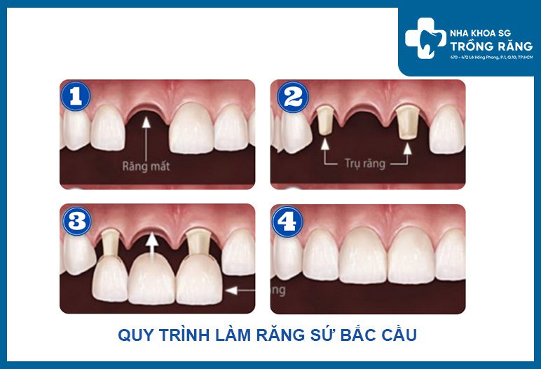 Năm 2022 bắc cầu răng sứ giá bao nhiêu tiền?