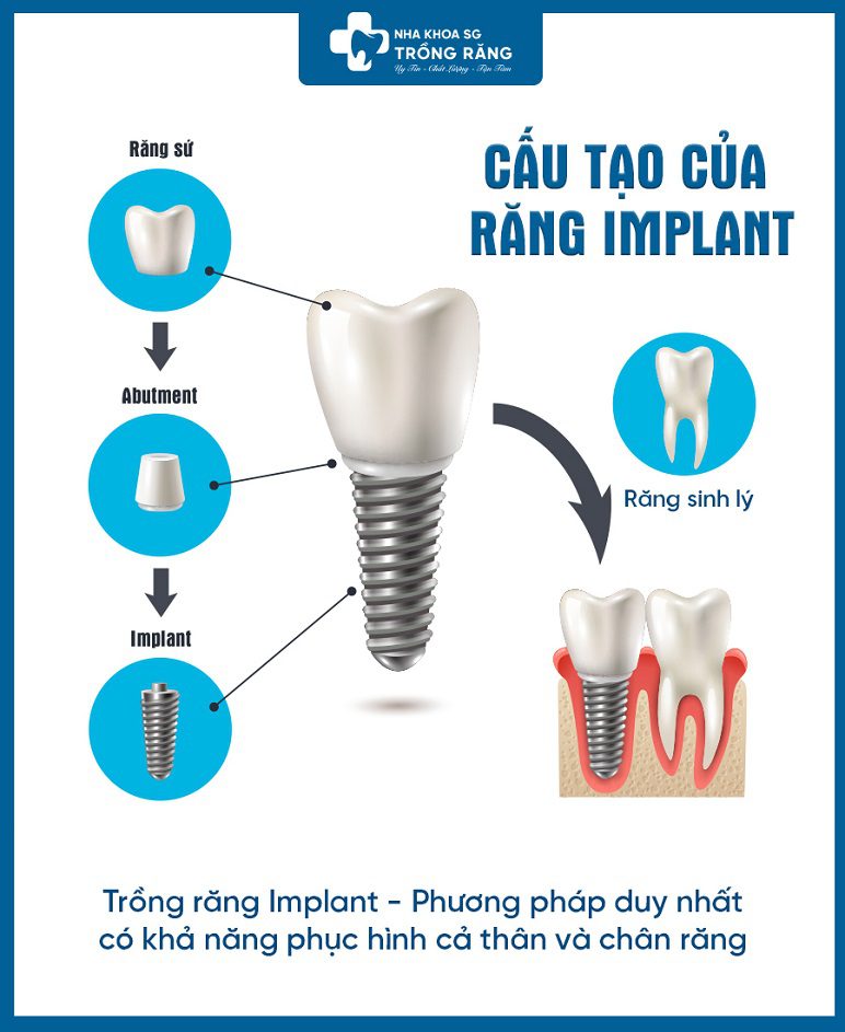 cấu tạo của răng implant