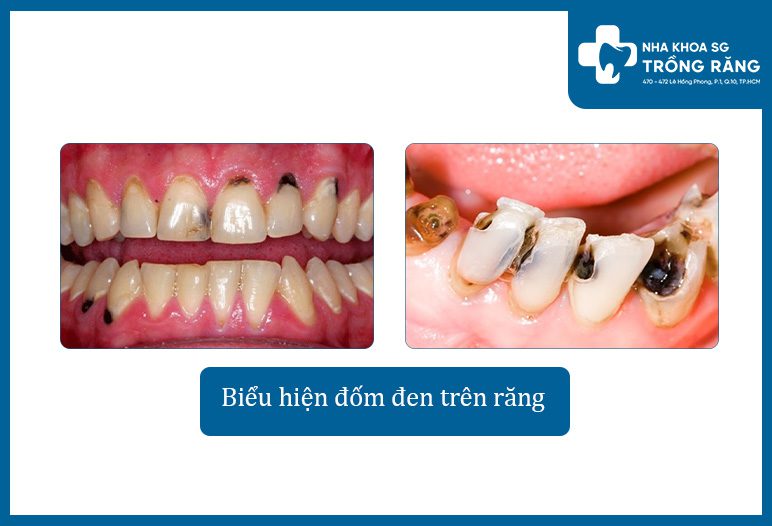 bieu hien dom den tren rang do sau rang