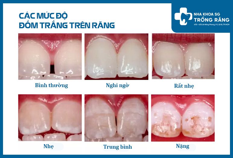 cac muc do dom trang tren rang