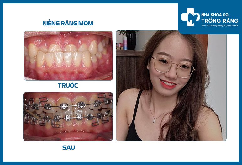 20-30 tuổi niềng răng bao nhiêu tiền? Thời gian bao lâu?