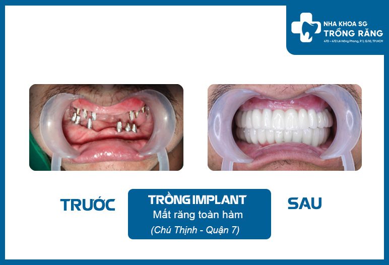 trong rang implant mat rang toan ham Hình ảnh trước sau khi trồng răng