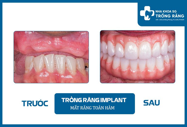 trong rang implant truoc sau Hình ảnh trước và sau khi trồng implant