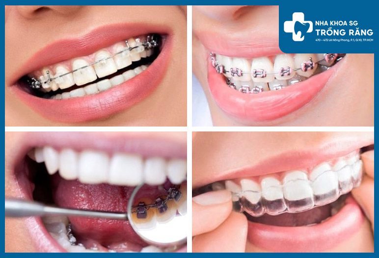 20-30 tuổi niềng răng bao nhiêu tiền? Thời gian bao lâu?