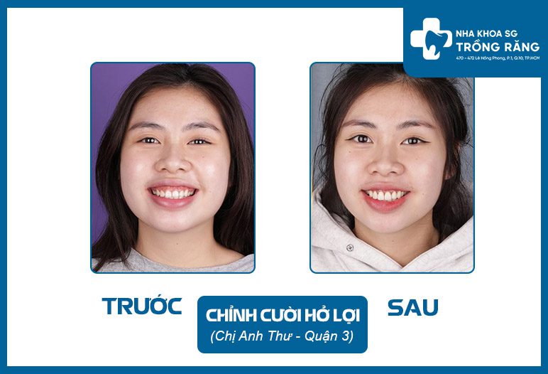 cuoi ho loi cuoi ho loi