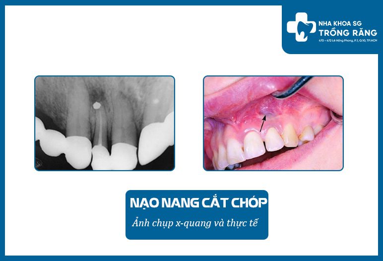 Cắt chóp nạo nang và những điều cần biết