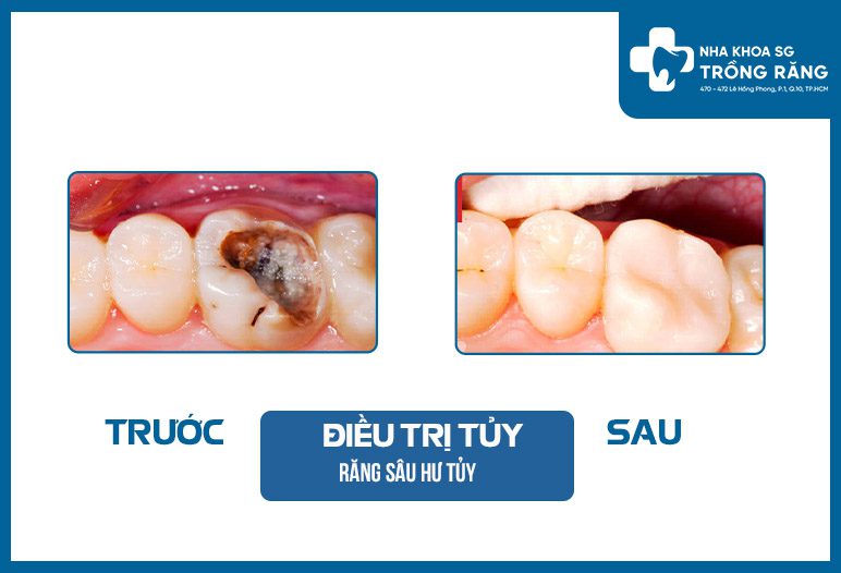 hinh anh truoc sau chua tuy