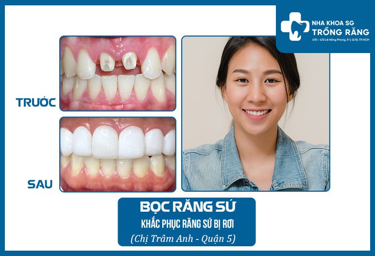 bọc lại răng sứ bị rơi ra