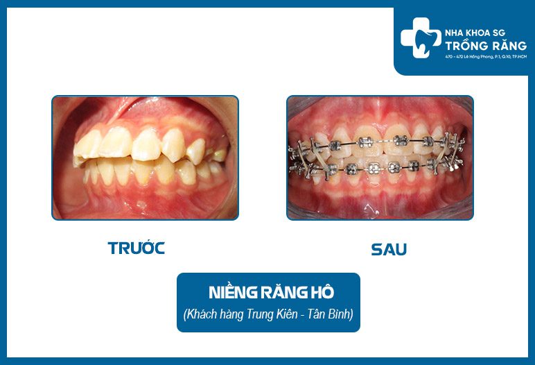 hình ảnh niềng răng hô