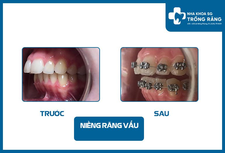 Niềng răng hình ảnh trước sau