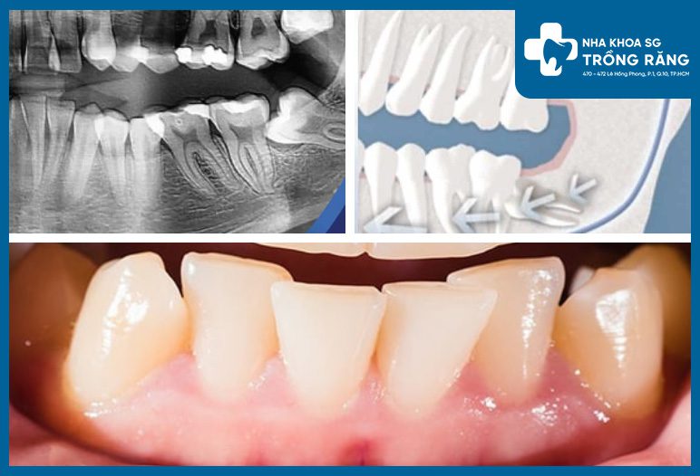 rang xo lech do moc rang khon