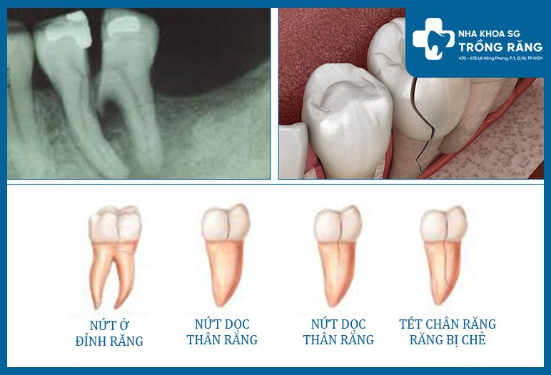x quang tet chan rang