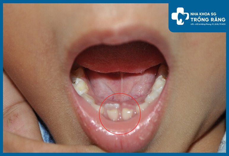 bieu hien rang moc lay