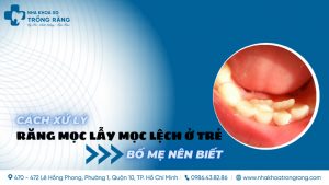 cach xu ly rang moc lay moc lech o tre