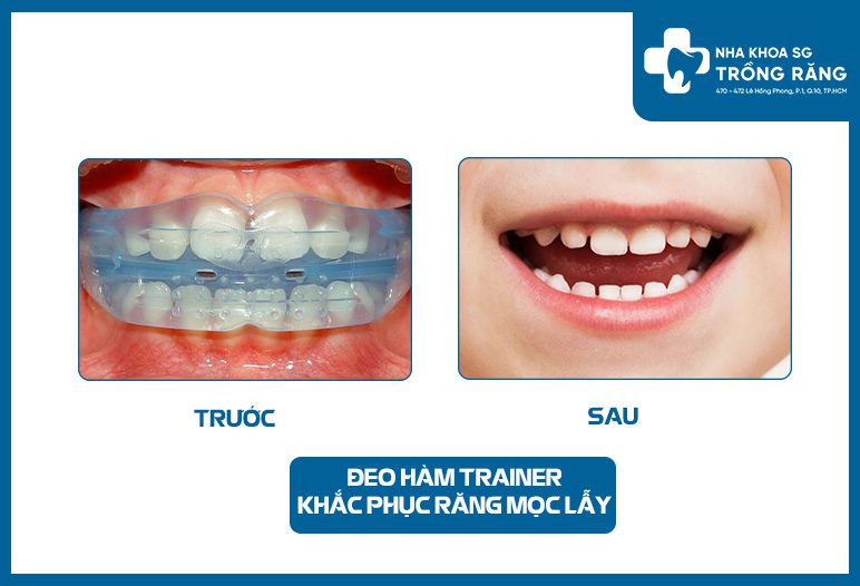 deo ham trainer khac phuc rang moc lay