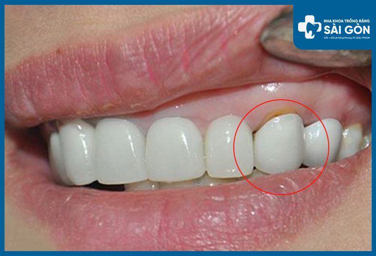 Bọc răng sứ bị hở