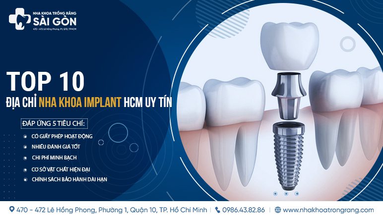 top 10 dia chi nha khoa implant hcm Top 10 Địa chỉ Nha khoa Implant HCM uy tín